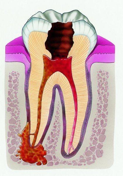 periodontit22.jpg